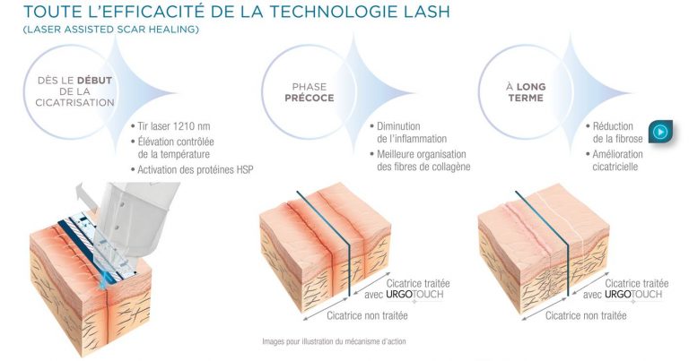 Optimisation de la cicatrisation - Carré Esthétique Lafayette